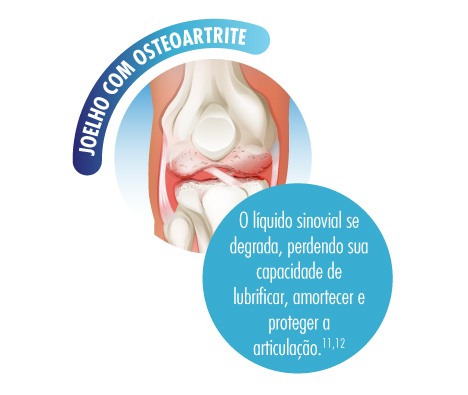 Knee diagram cartilage joint fluid breakdown