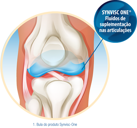 Synvisc-One knee fluid replace cushioning